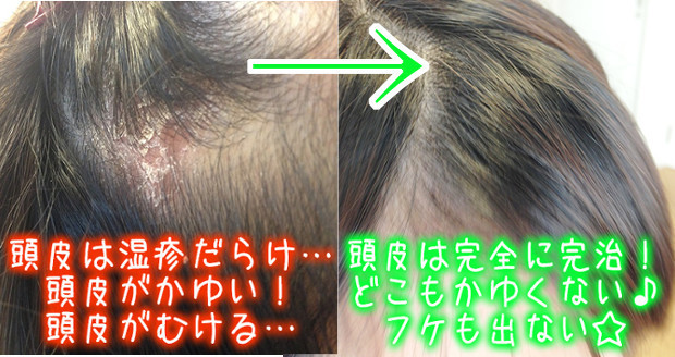 頭皮がむける 脂漏性皮膚炎の治し方 私の体験談